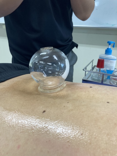 カッピング（吸い球）を体験