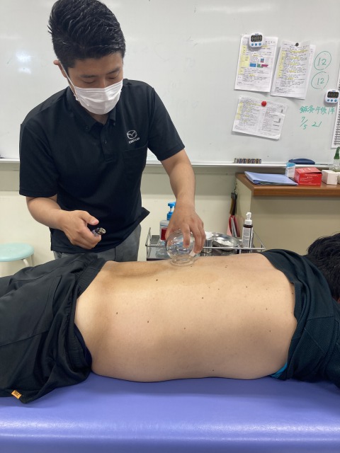 カッピング（吸い球）を体験